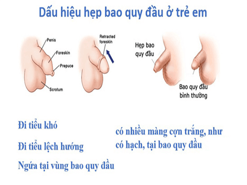 Dấu hiệu trẻ em bị hẹp bao quy đầu