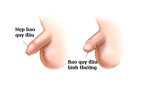 Hình ảnh về bao quy đầu